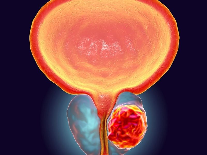 uretra-darliginda-tedavi-yontemleri-1