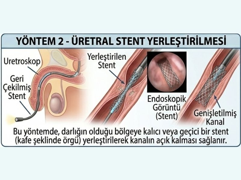 uretra-genisletme-tedavisi
