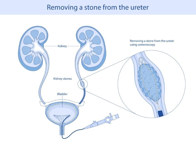 uretra-taslari-tanisi-nasil-konur